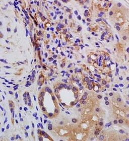 Paraffin-embedded human kidney carcinoma tissue fixed with 4% paraformaldehyde.Antigen retrieval by boiling with citrate buffer.Blocking buffer is goat serum (37 degrees for 20 min.). Renin antibody at 1:200 dilution with overnight incubation at 4 degrees