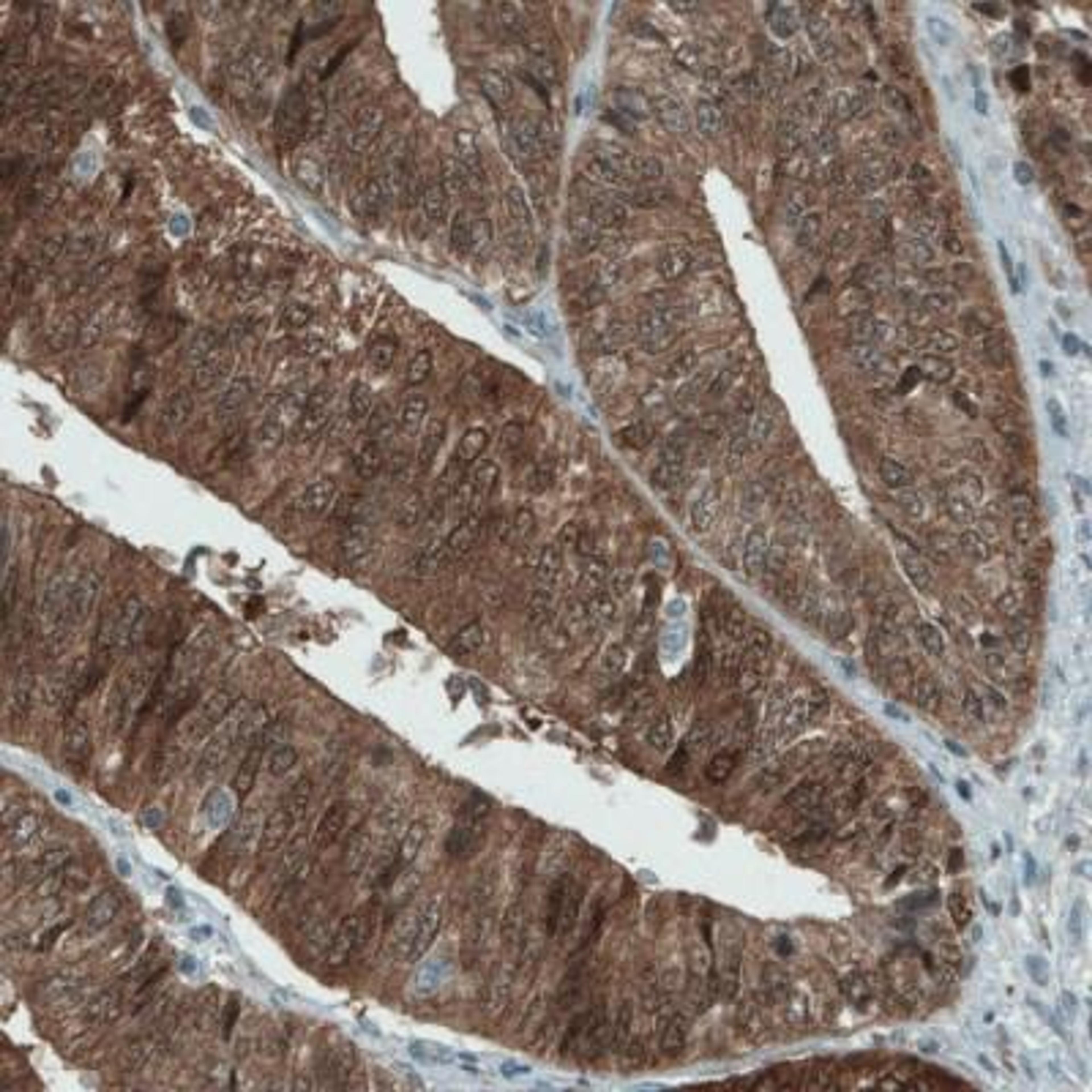 Immunohistochemistry: ASRGL1 Antibody (CL1679) [NBP2-42378] - Staining of human endometrial cancer shows strong immunoreactivity in tumor cells.