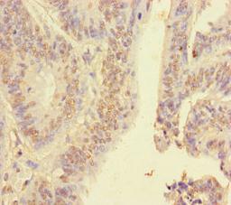 Immunohistochemistry of paraffin-embedded human colon cancer using CSB-PA010602DA01HU at dilution of 1:100
