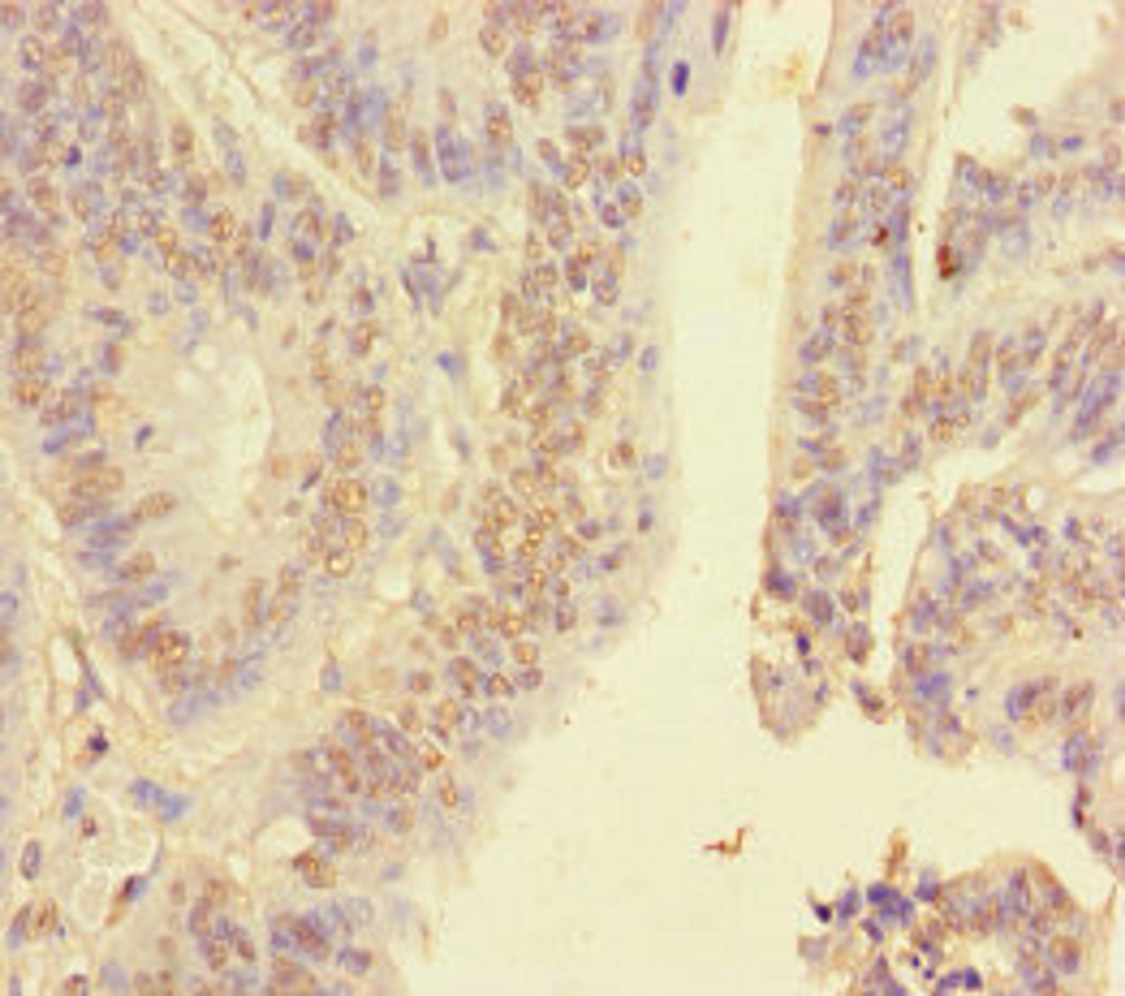 Immunohistochemistry of paraffin-embedded human colon cancer using CSB-PA010602DA01HU at dilution of 1:100