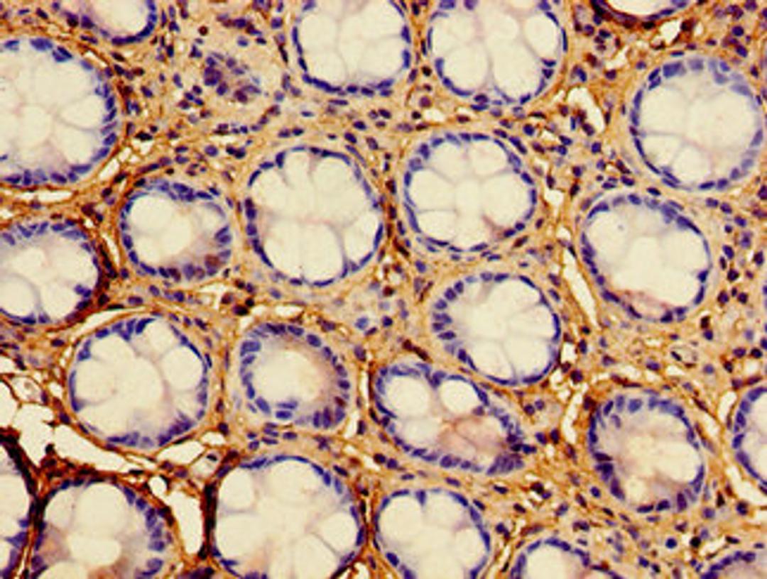 Immunohistochemistry of paraffin-embedded human colon cancer using CSB-PA010112LA01HU at dilution of 1:100