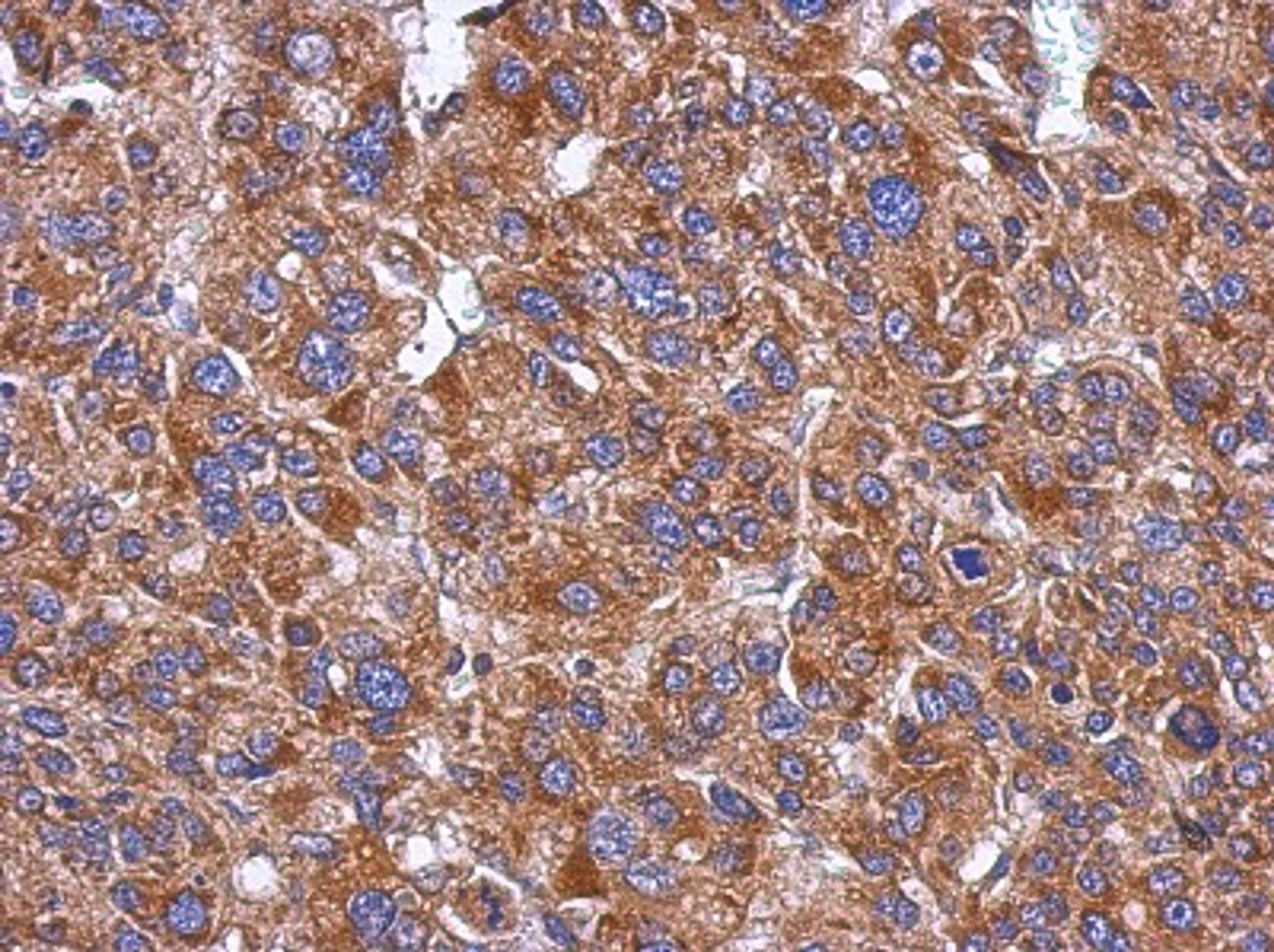 Immunohistochemistry-Paraffin: CYP26A1 Antibody [NBP2-16061] - Immunohistochemical analysis of paraffin-embedded Hepatoma, using antibody at 1:500 dilution.