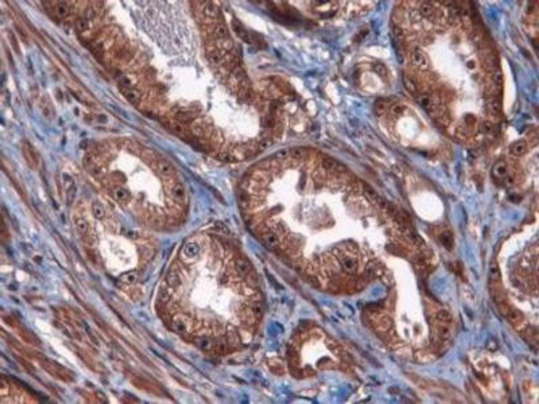 Immunohistochemistry: ATF3 Antibody [NBP1-02935] - Analysis of ATF3 in human prostate using Fast Red with hematoxylin counterstain.