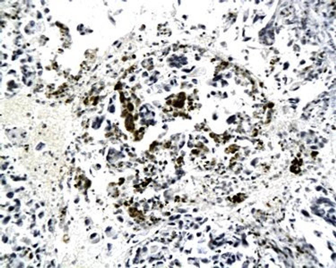 Immunohistochemical analysis of paraffin-embedded human lung cancer tissue using  Kiss1 antibody