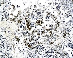 Immunohistochemical analysis of paraffin-embedded human lung cancer tissue using Kiss1 antibody