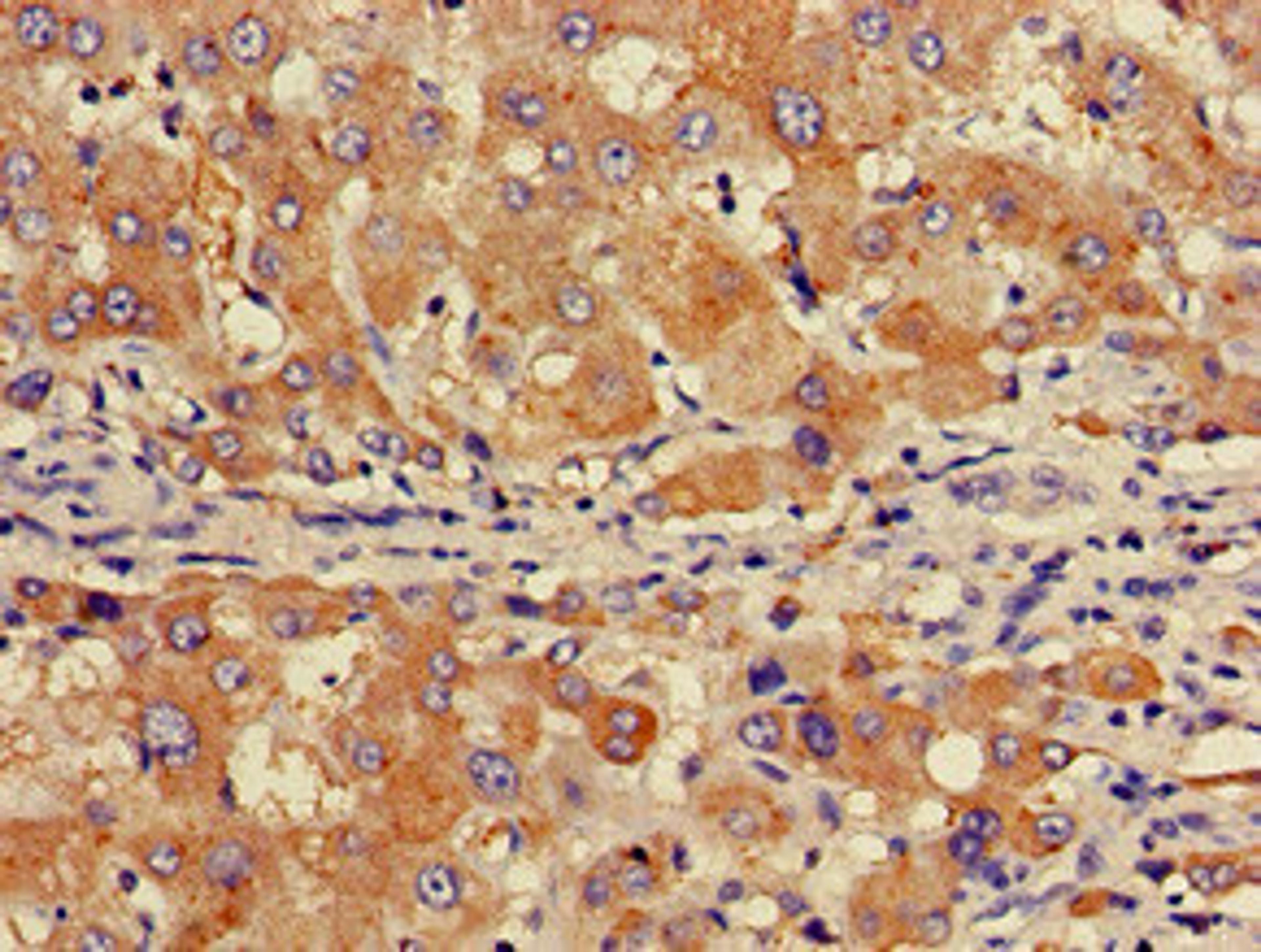 Immunohistochemistry of paraffin-embedded human liver cancer using CSB-PA861986LA01HU at dilution of 1:100