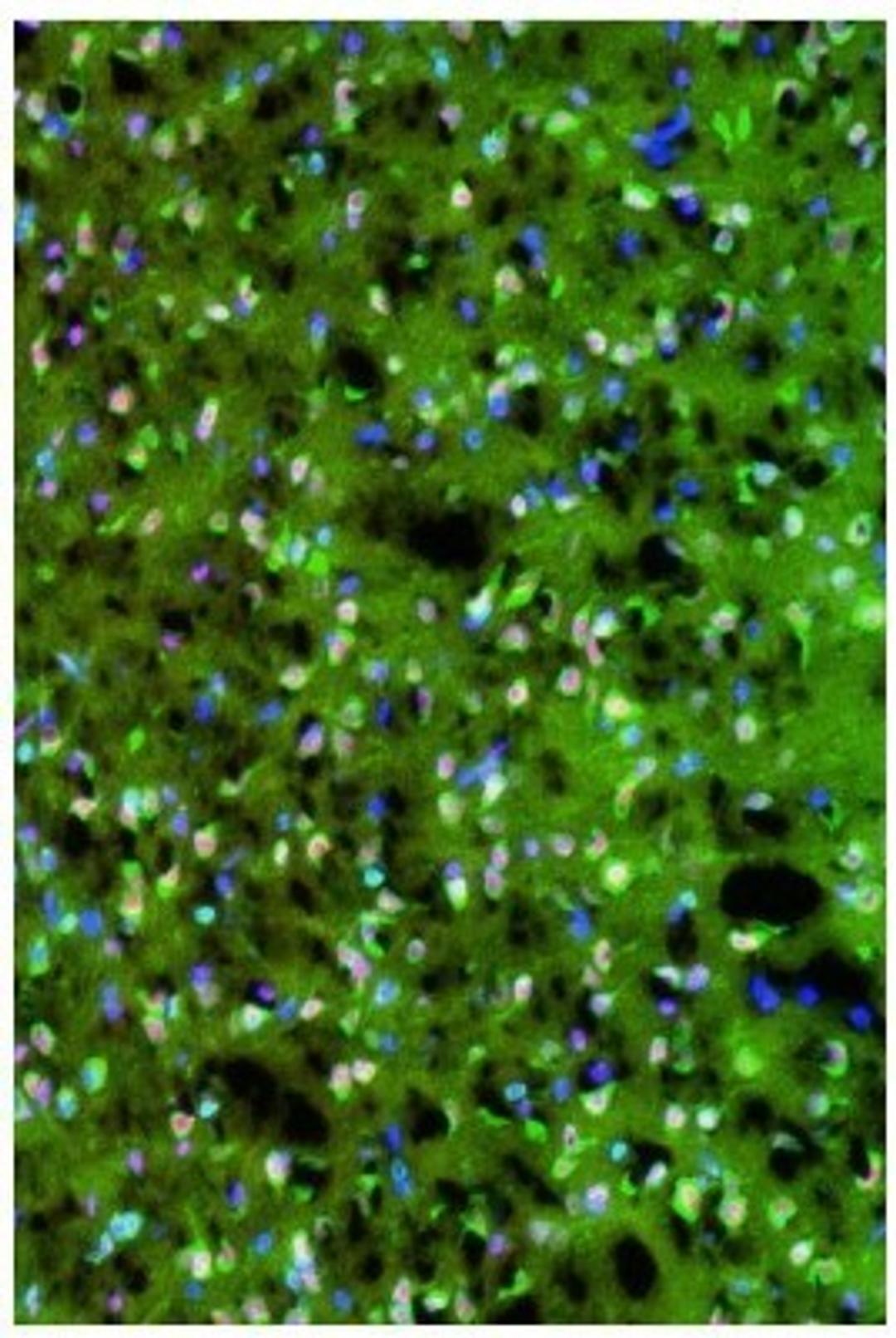 Immunocytochemistry/Immunofluorescence: PKM2 Antibody [NBP1-48308] - IF analysis of PKM2 in  frozen sections of rat glioblastoma tissue. Image courtsey of anonymous customer review.