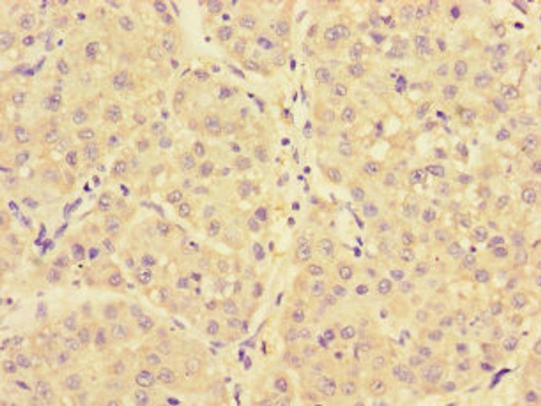 Immunohistochemistry of paraffin-embedded human liver cancer using CSB-PA015459LA01HU at dilution of 1:100