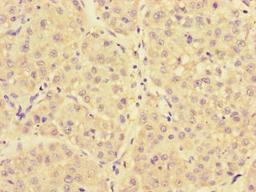 Immunohistochemistry of paraffin-embedded human liver cancer using CSB-PA015459LA01HU at dilution of 1:100