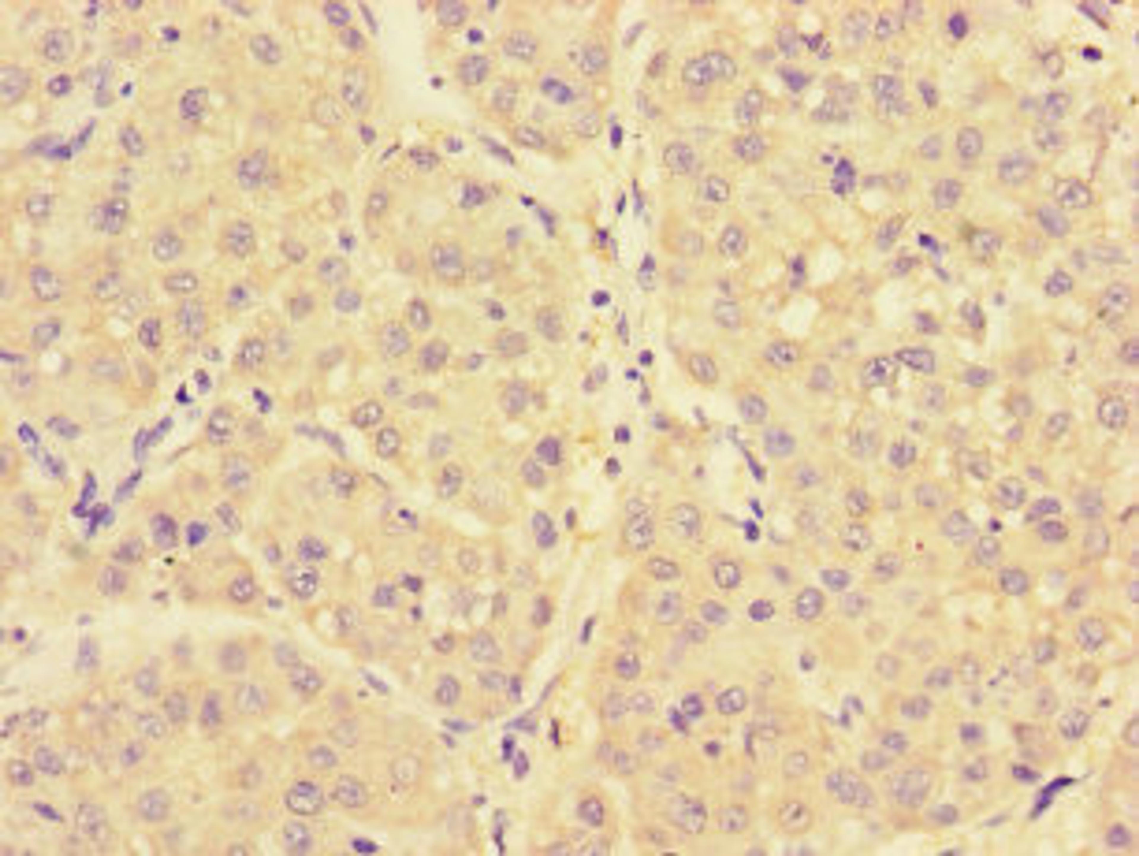 Immunohistochemistry of paraffin-embedded human liver cancer using CSB-PA015459LA01HU at dilution of 1:100