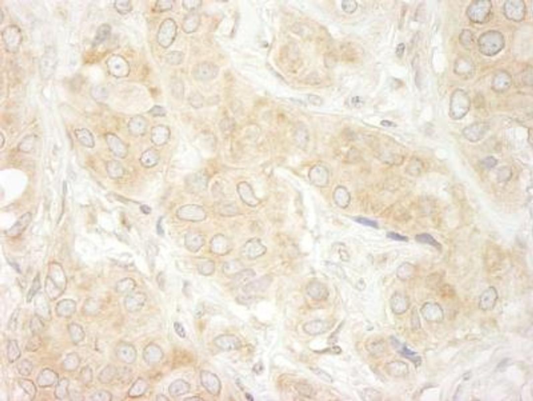 Immunohistochemistry-Paraffin: DDX19B Antibody [NB100-760] - Human breast carcinoma. Antibody used at a dilution of 1:200 (1ug/ml).