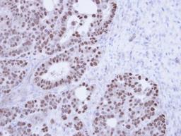 Immunohistochemistry-Paraffin: NXF1 Antibody [NBP1-31649] - Paraffin-embedded NCIN87 Xenograft, using antibody at 1:100 dilution.