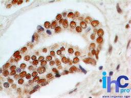 Immunohistochemistry-Paraffin: Rad9 Antibody (93A535) [NB120-13600] - Formalin-fixed, paraffin-embedded human prostate adenocarcinoma stained with RAD9 antibody at 5 ug/ml.    Staining of formalin-fixed tissues is enhanced by boiling tissue sections in 10 mM sodium citrate buffer, pH 6.0 for 10-20 min followed by cooling at RT for 20 min.