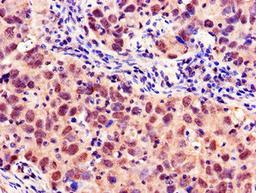 Immunohistochemistry of paraffin-embedded human pancreatic cancer using CSB-PA015264LA01HU at dilution of 1:100