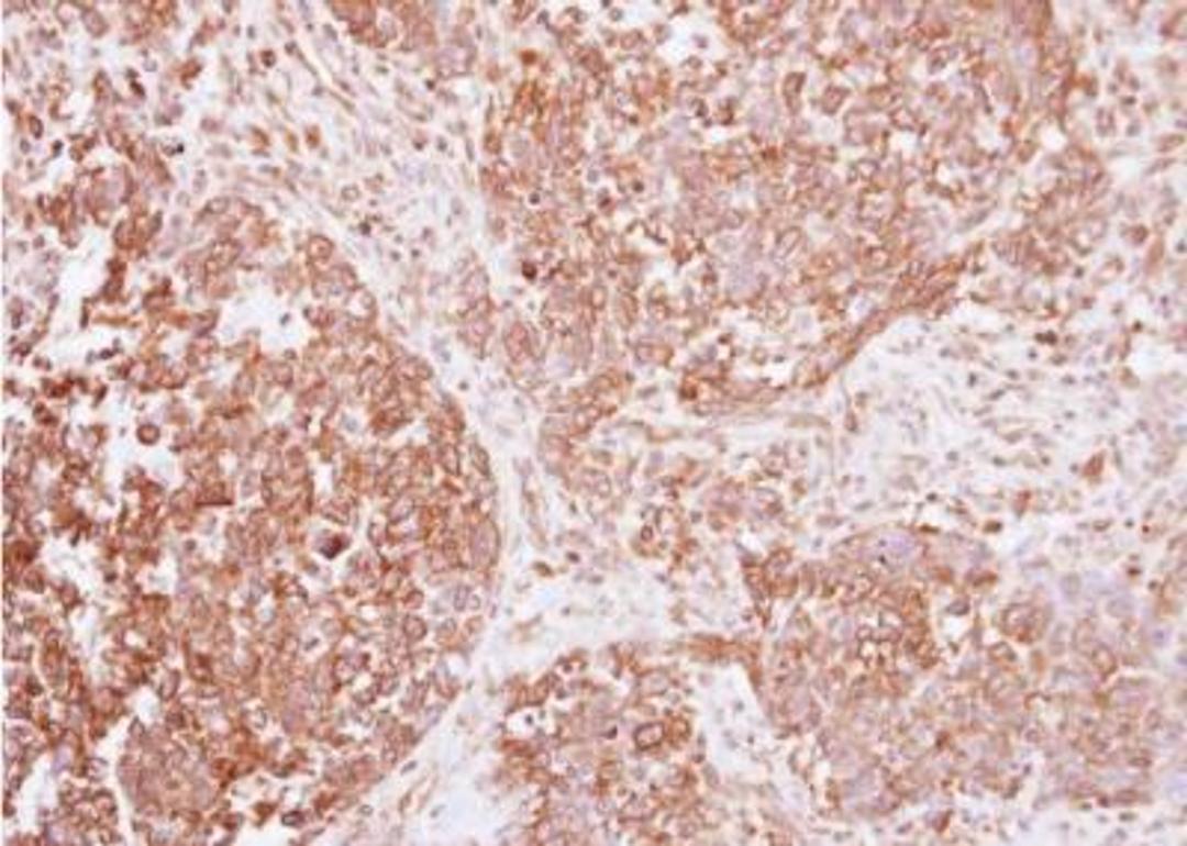 Immunohistochemistry-Paraffin: Insulin R/CD220 Antibody [NBP2-16970] - Analysis of paraffin-embedded human lung cancer, using Insulin Receptor antibody at 1:250 dilution.