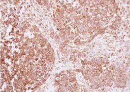 Immunohistochemistry-Paraffin: Insulin R/CD220 Antibody [NBP2-16970] - Analysis of paraffin-embedded human lung cancer, using Insulin Receptor antibody at 1:250 dilution.