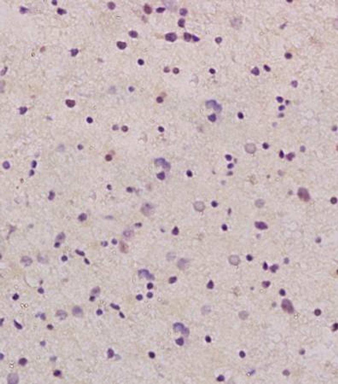 IHC-P of human glioma tissue (GDNF antibody at 1:200)