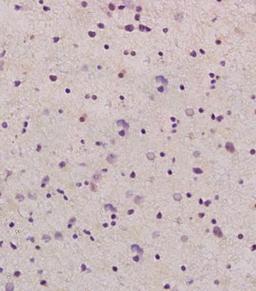 IHC-P of human glioma tissue (GDNF antibody at 1:200)