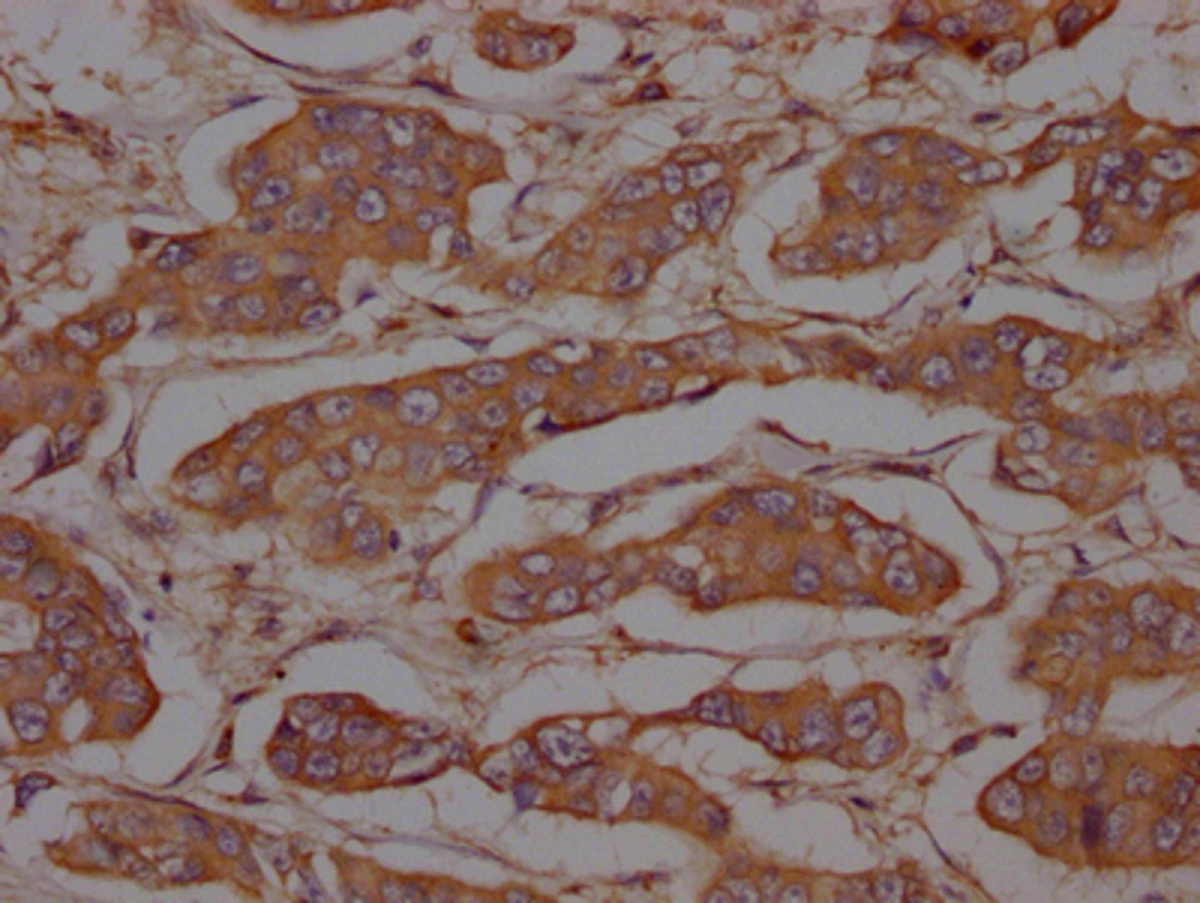 IHC image of CSB-RA634199A0HU diluted at 1:100 and staining in paraffin-embedded human breast cancer performed on a Leica BondTM system. After dewaxing and hydration, antigen retrieval was mediated by high pressure in a citrate buffer (pH 6.0). Section was blocked with 10% normal goat serum 30min at RT. Then primary antibody (1% BSA) was incubated at 4℃ overnight. The primary is detected by a Goat anti-rabbit IgG polymer labeled by HRP and visualized using 0.05% DAB.