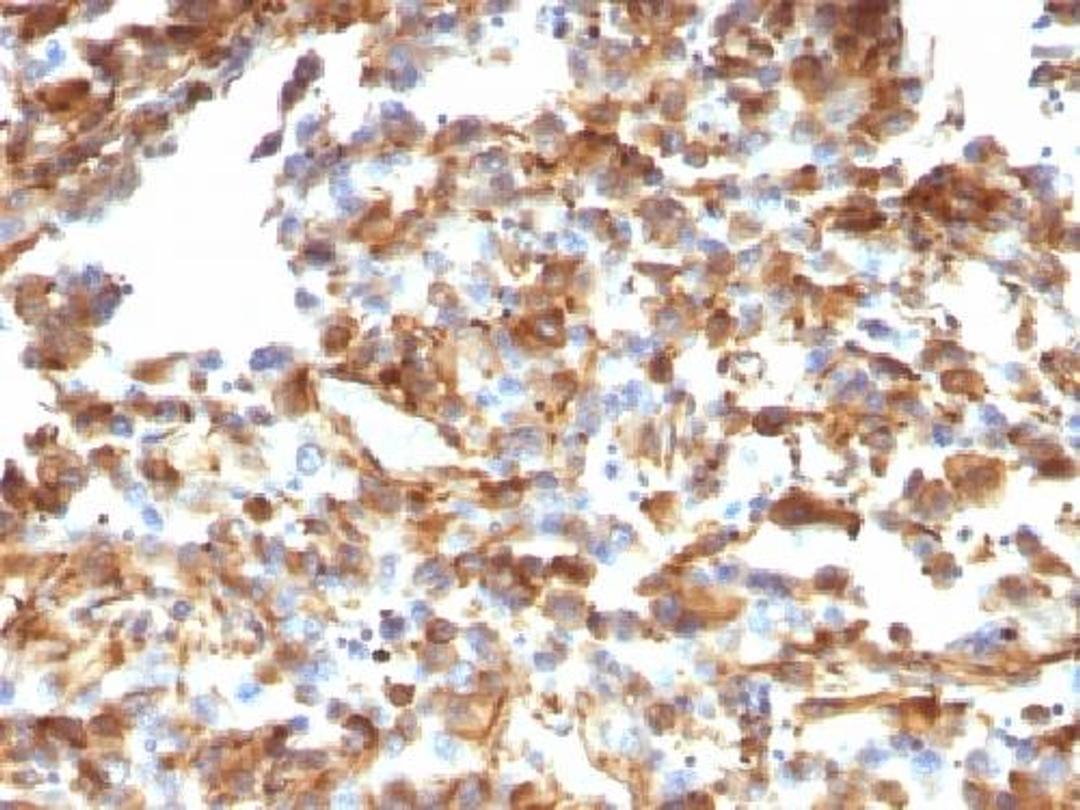 Immunohistochemical staining of human Melanoma tissue using VIM antibody