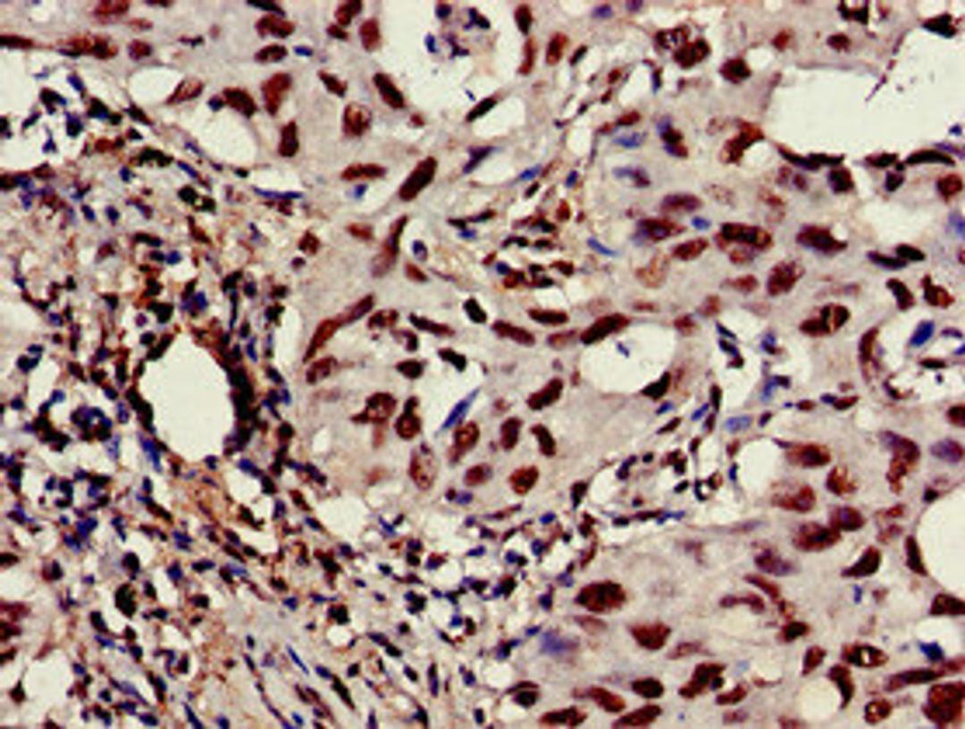 Immunohistochemistry of paraffin-embedded human lung cancer using CSB-PA004551EA01HU at dilution of 1:100