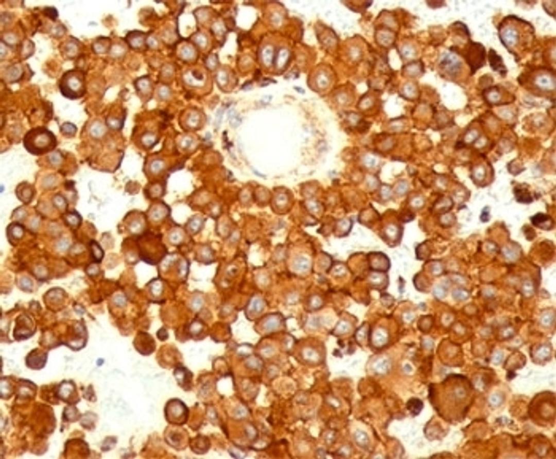 IHC testing of human melanoma stained with CD63 antibody (MX49.129.5).