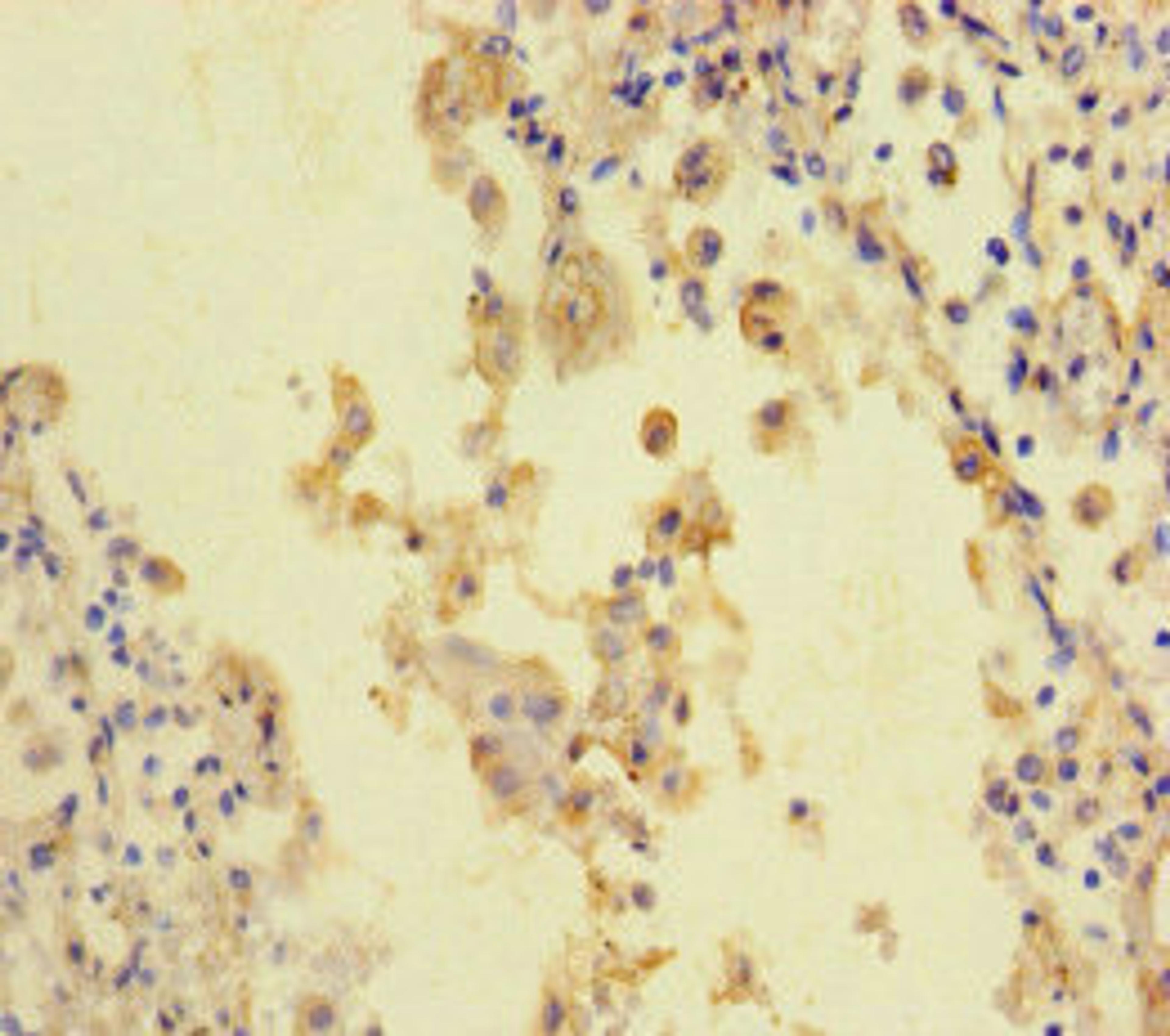 Immunohistochemistry of paraffin-embedded human lung cancer using CSB-PA618008LA01HU at dilution of 1:100