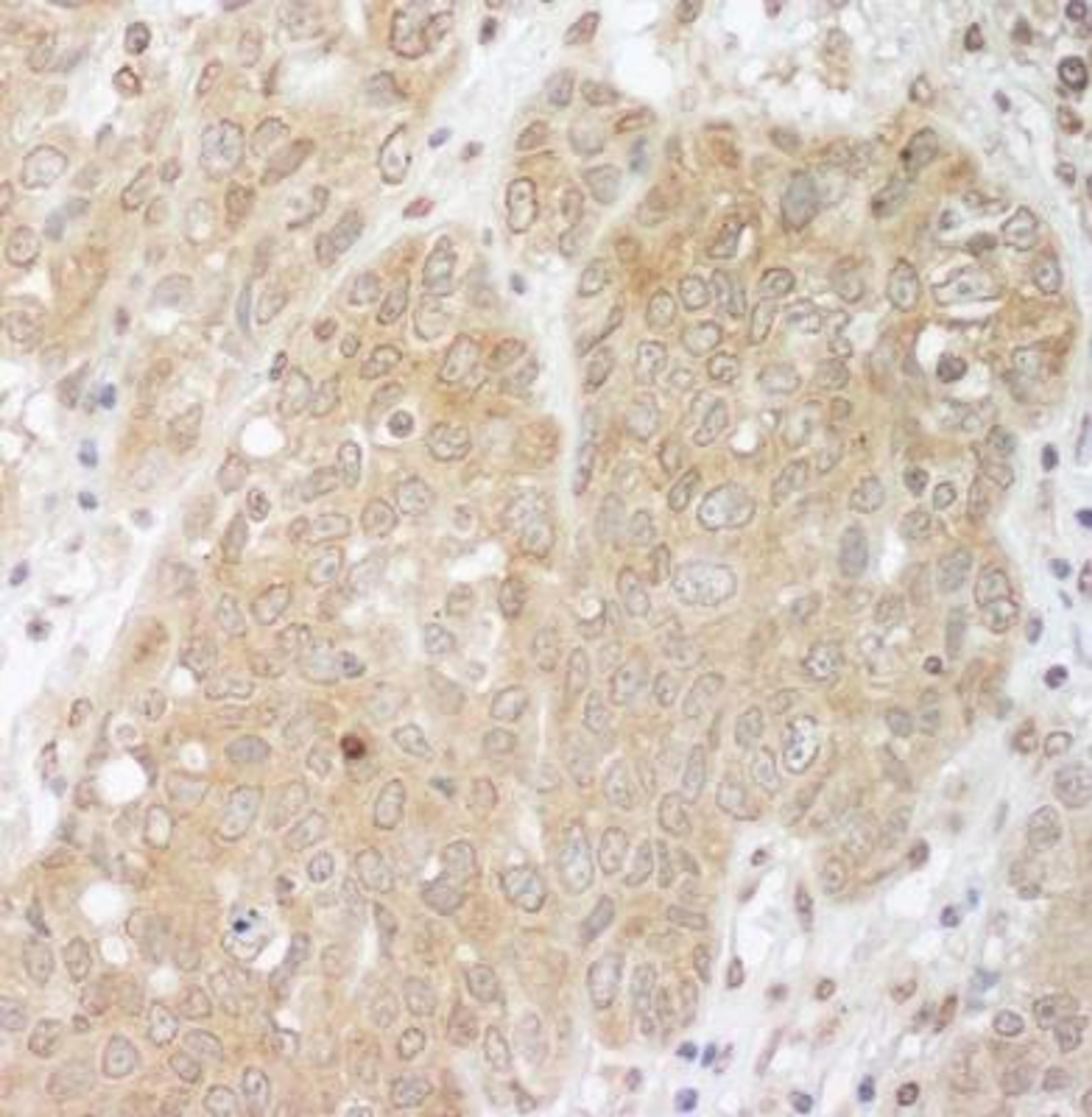 Immunohistochemistry-Paraffin: CBLB Antibody [NBP1-49919] - Sample: FFPE section of human ovarian carcinoma.  Antibody was used at a dilution of 1:1,000 (1ug/ml). Detection: DAB