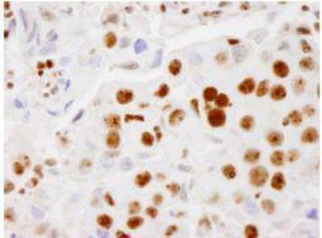 Immunohistochemistry-Paraffin: PELP1 Antibody [NB200-331] - FFPE section of human breast adenocarcinoma.  Affinity purified rabbit anti- PELP1/MNAR used at a dilution of 1:500.