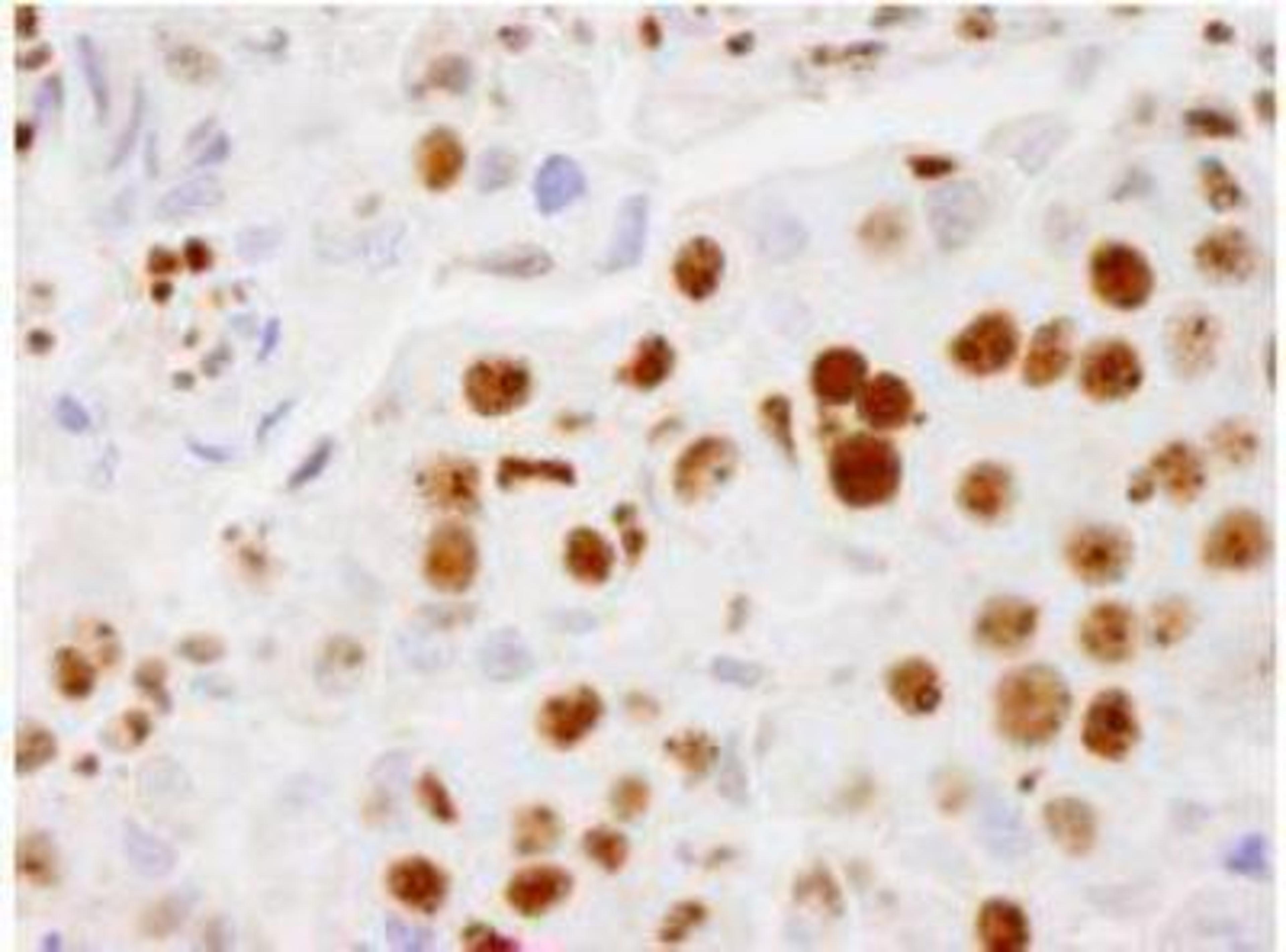 Immunohistochemistry-Paraffin: PELP1 Antibody [NB200-331] - FFPE section of human breast adenocarcinoma.  Affinity purified rabbit anti- PELP1/MNAR used at a dilution of 1:500.