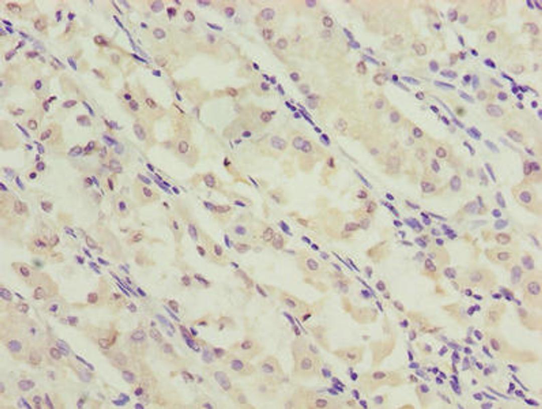 Immunohistochemistry of paraffin-embedded human gastric cancer using CSB-PA881008LA01HU at dilution of 1:100