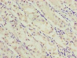 Immunohistochemistry of paraffin-embedded human gastric cancer using CSB-PA881008LA01HU at dilution of 1:100