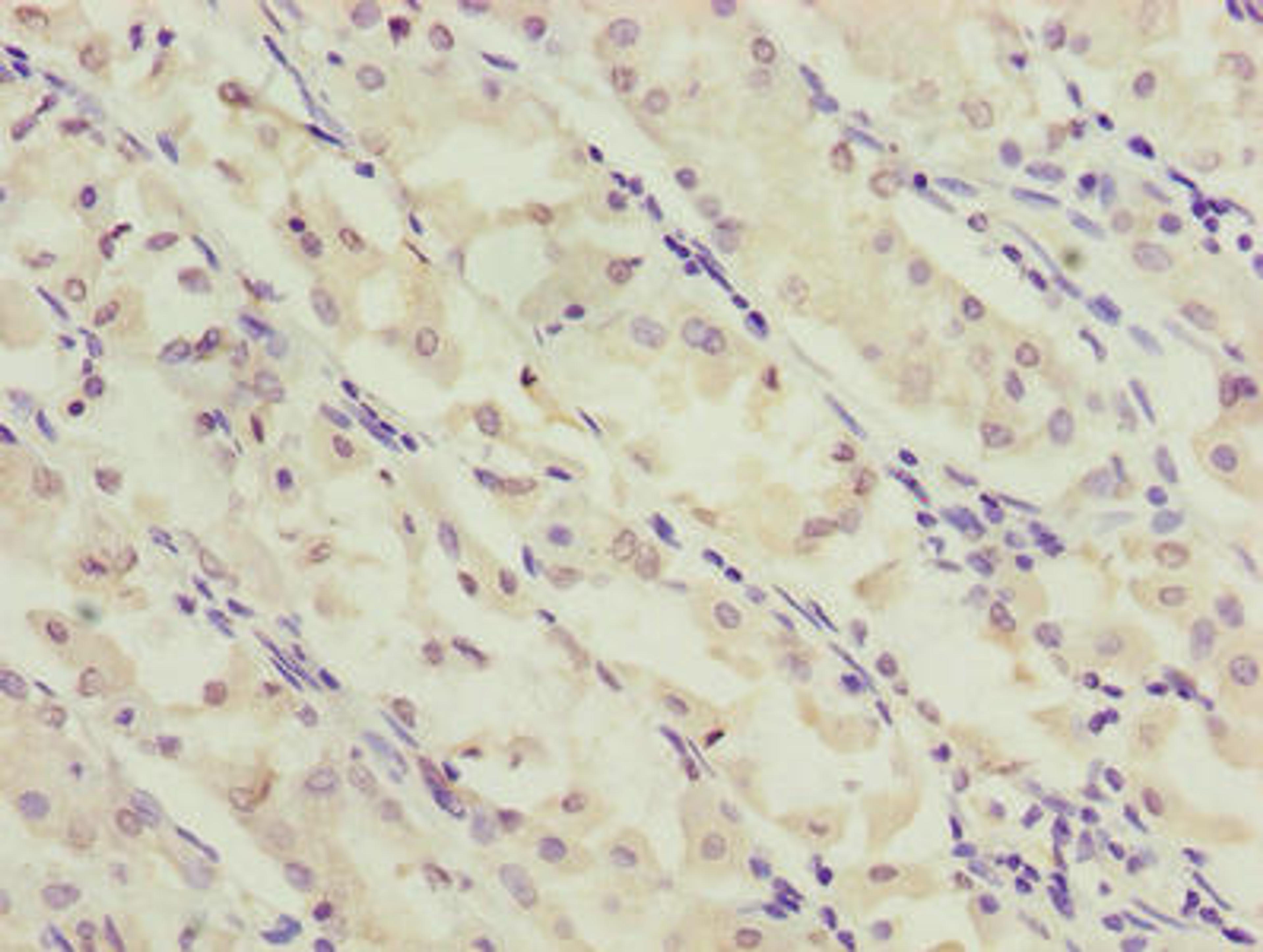 Immunohistochemistry of paraffin-embedded human gastric cancer using CSB-PA881008LA01HU at dilution of 1:100
