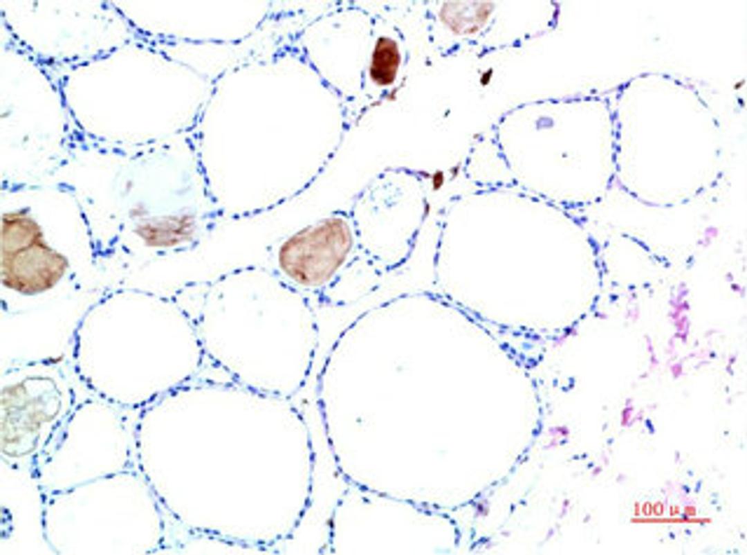 Immunohistochemical analysis of paraffin-embedded Human Liver Carcinoma Tissue using TTR Mouse mAb diluted at 1:200.