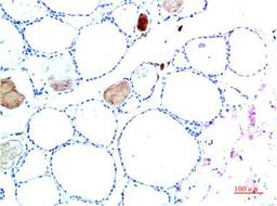 Immunohistochemical analysis of paraffin-embedded Human Liver Carcinoma Tissue using TTR Mouse mAb diluted at 1:200.