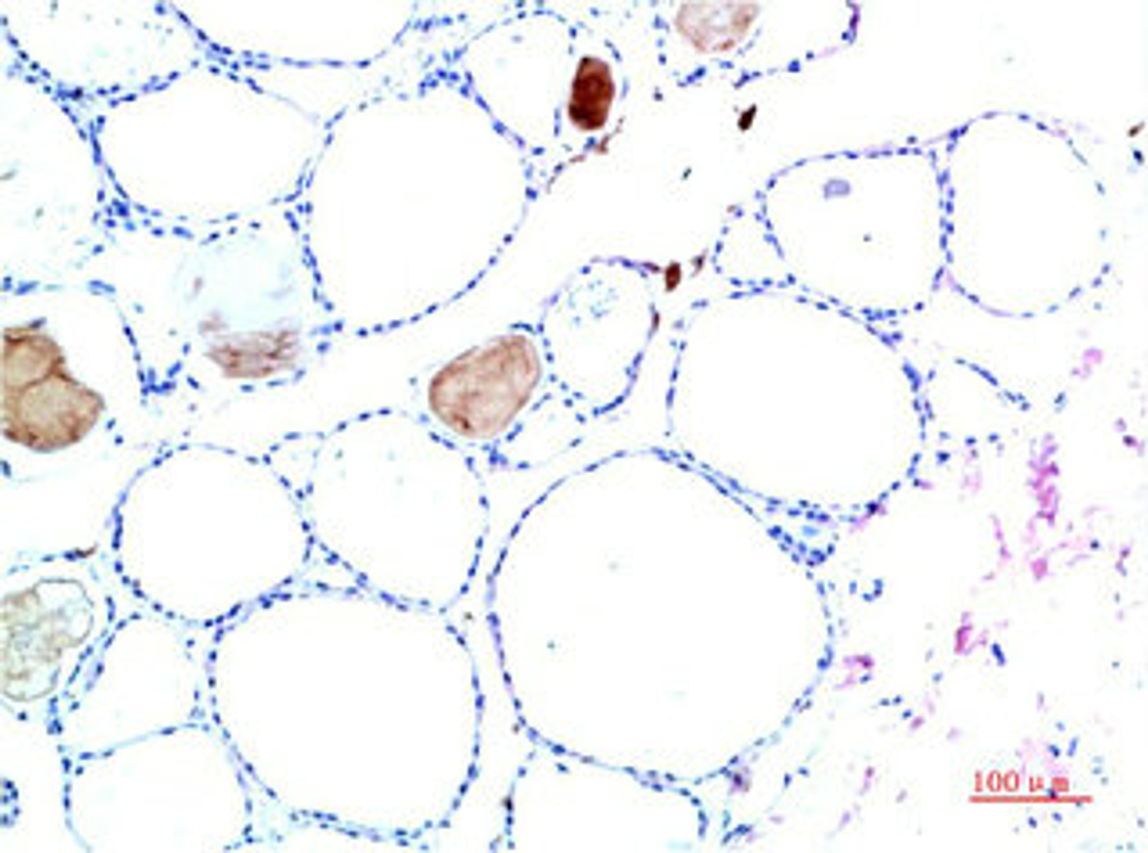 Immunohistochemical analysis of paraffin-embedded Human Liver Carcinoma Tissue using TTR Mouse mAb diluted at 1:200.