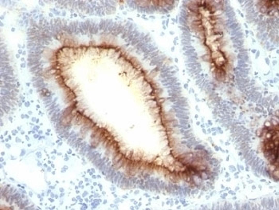 Formalin-fixed, paraffin-embedded human colon carcinoma stained with CEA antibody (SPM330).