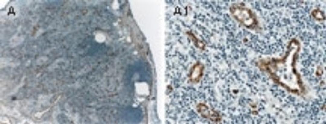 Immunohistochemistry-Paraffin: ASK1 Antibody [NB100-56077] - Formalin-fixed paraffin-embedded tissue section of human reactive tonsil stained for ASK1 expression using NB100-56077 at 1:2000.  A and A1. Low and high magnification, respectively.  ASK1 expression was seen in the vasculature (endothelial cells). Hematoxylin-eosin counterstain.