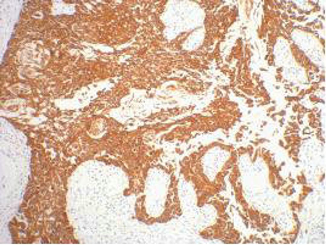 IHC staining of human gullet cancer tissue, diluted at 1:200.