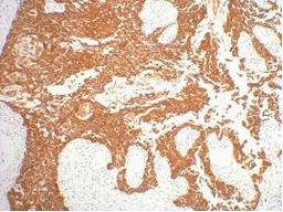 IHC staining of human gullet cancer tissue, diluted at 1:200.