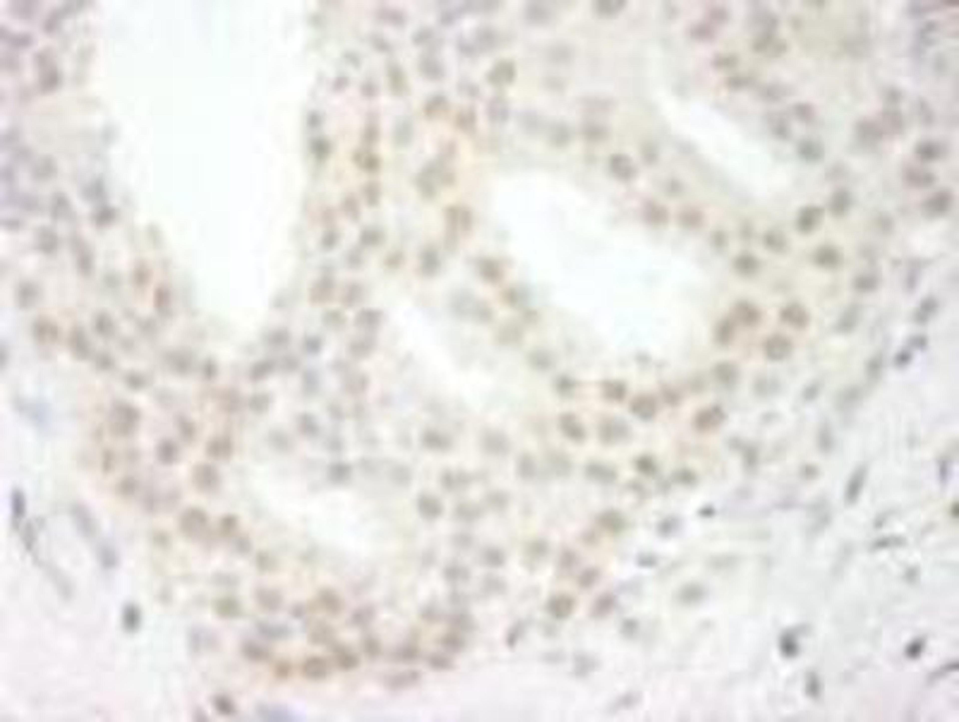 Immunohistochemistry-Paraffin: USP34 Antibody [NB100-2863] - FFPE section of human breast carcinoma.  Antibody used at a dilution of 1:250.