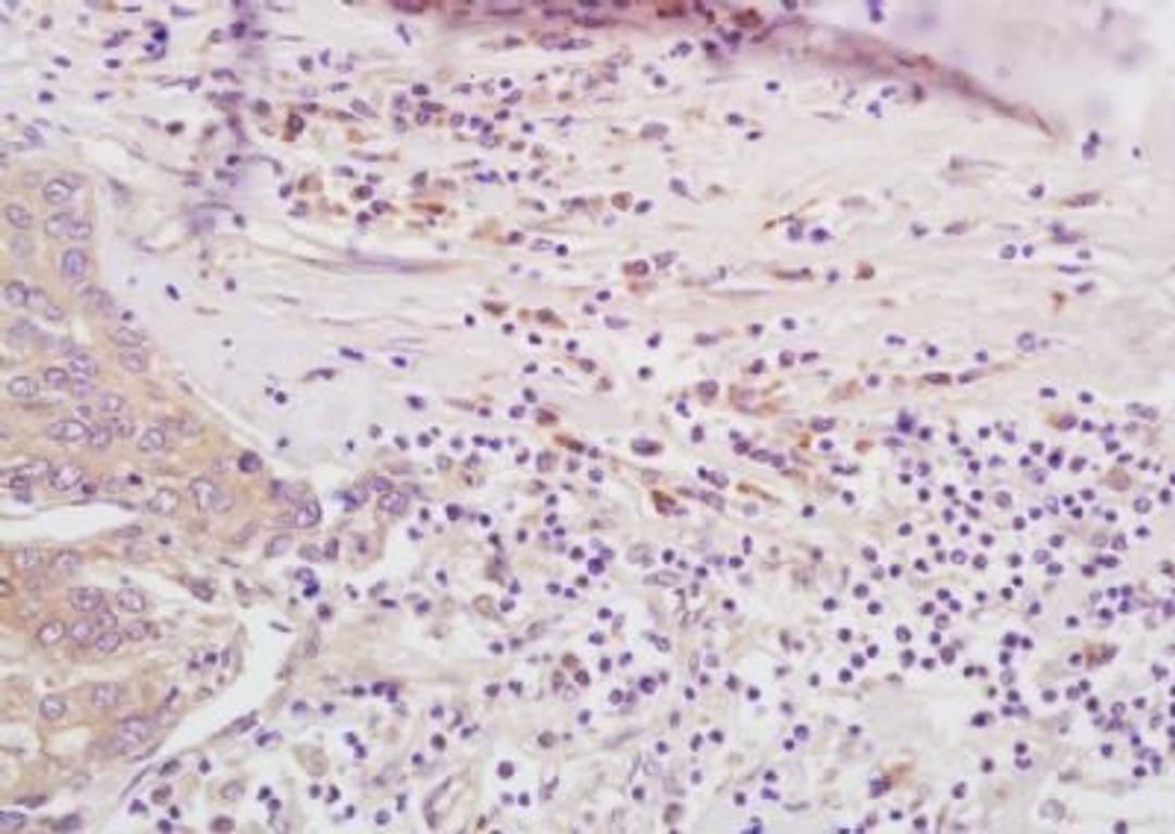 Immunohistochemical analysis of formalin-fixed paraffin embedded human lung carcinoma tissue using LMP7 antibody (dilution at 1:200)