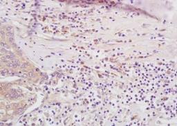 Immunohistochemical analysis of formalin-fixed paraffin embedded human lung carcinoma tissue using LMP7 antibody (dilution at 1:200)