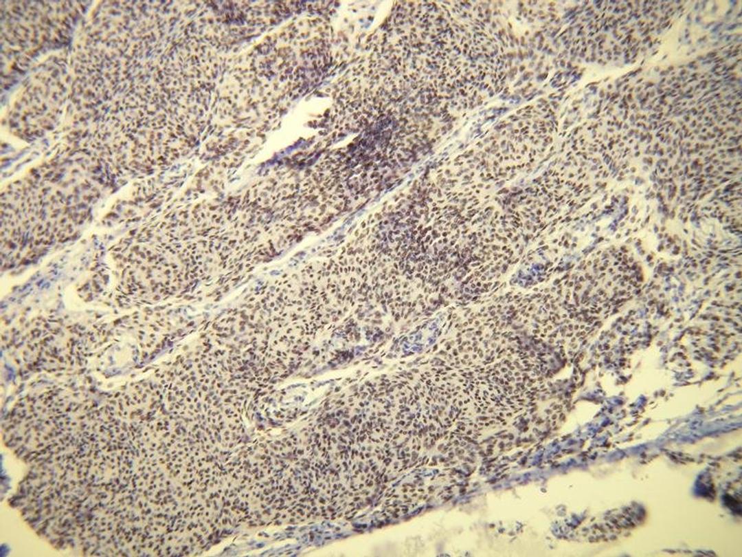 Immunohistochemical staining of human meningothelial meningioma tissue using PR antibody