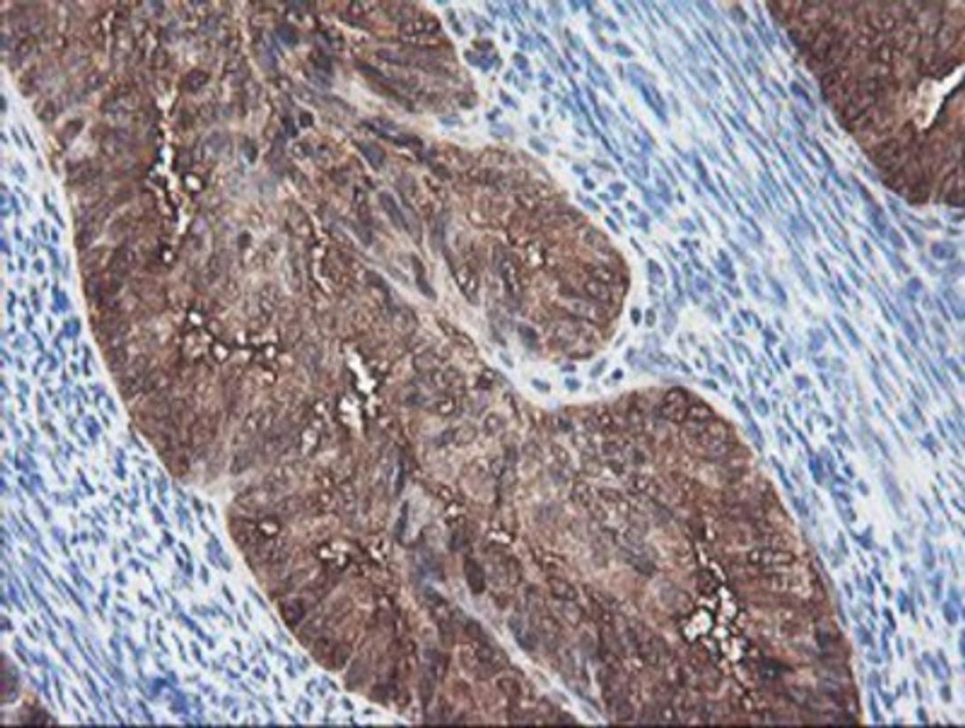 Immunohistochemistry-Paraffin: BCAT1 Antibody (3F5) [NBP2-01826] - Staining of paraffin-embedded Adenocarcinoma of Human endometrium tissue using anti-BCAT1 mouse monoclonal antibody.