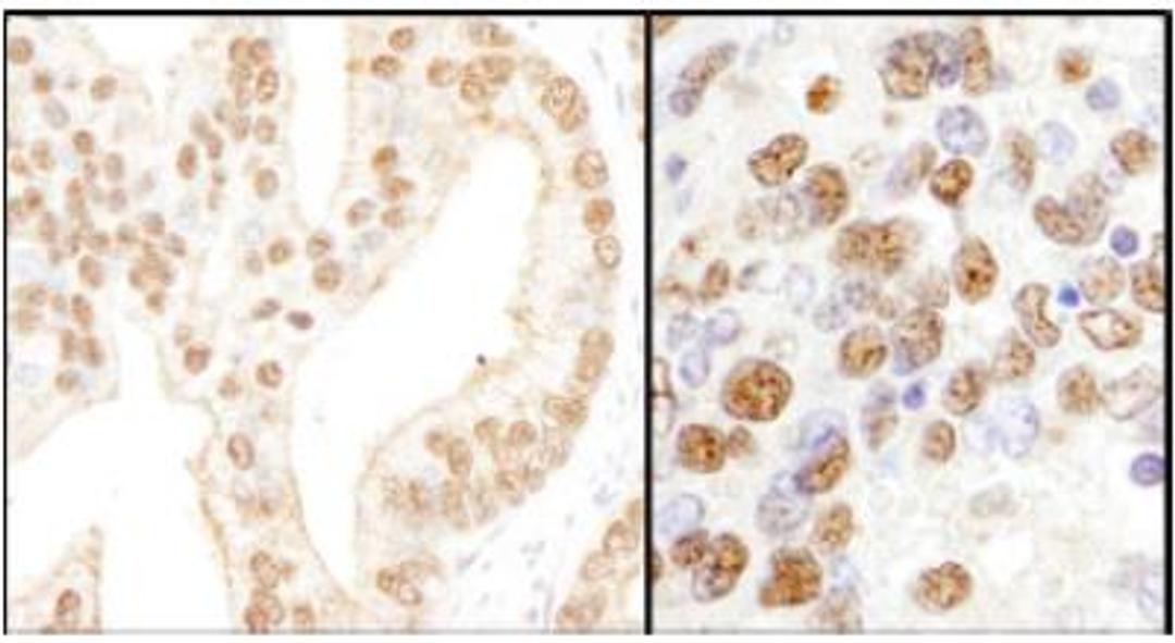 Immunohistochemistry-Paraffin: PHF8 Antibody [NB100-93314] - Section of human prostate carcinoma (left) and mouse teratoma (right). Dilution: 1:200 (1 ug/ml).