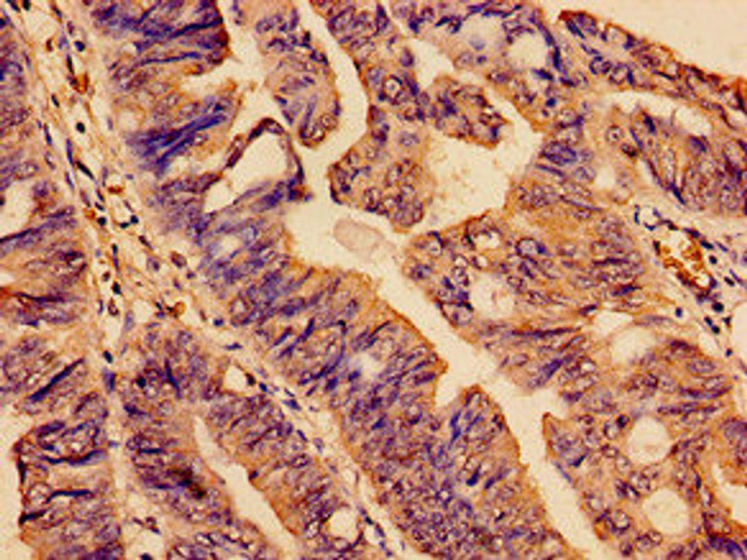 Immunohistochemistry analysis of human colon cancer using CSB-PA885725YA01HU at dilution of 1:100