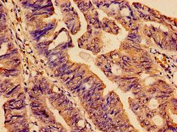 Immunohistochemistry analysis of human colon cancer using CSB-PA885725YA01HU at dilution of 1:100