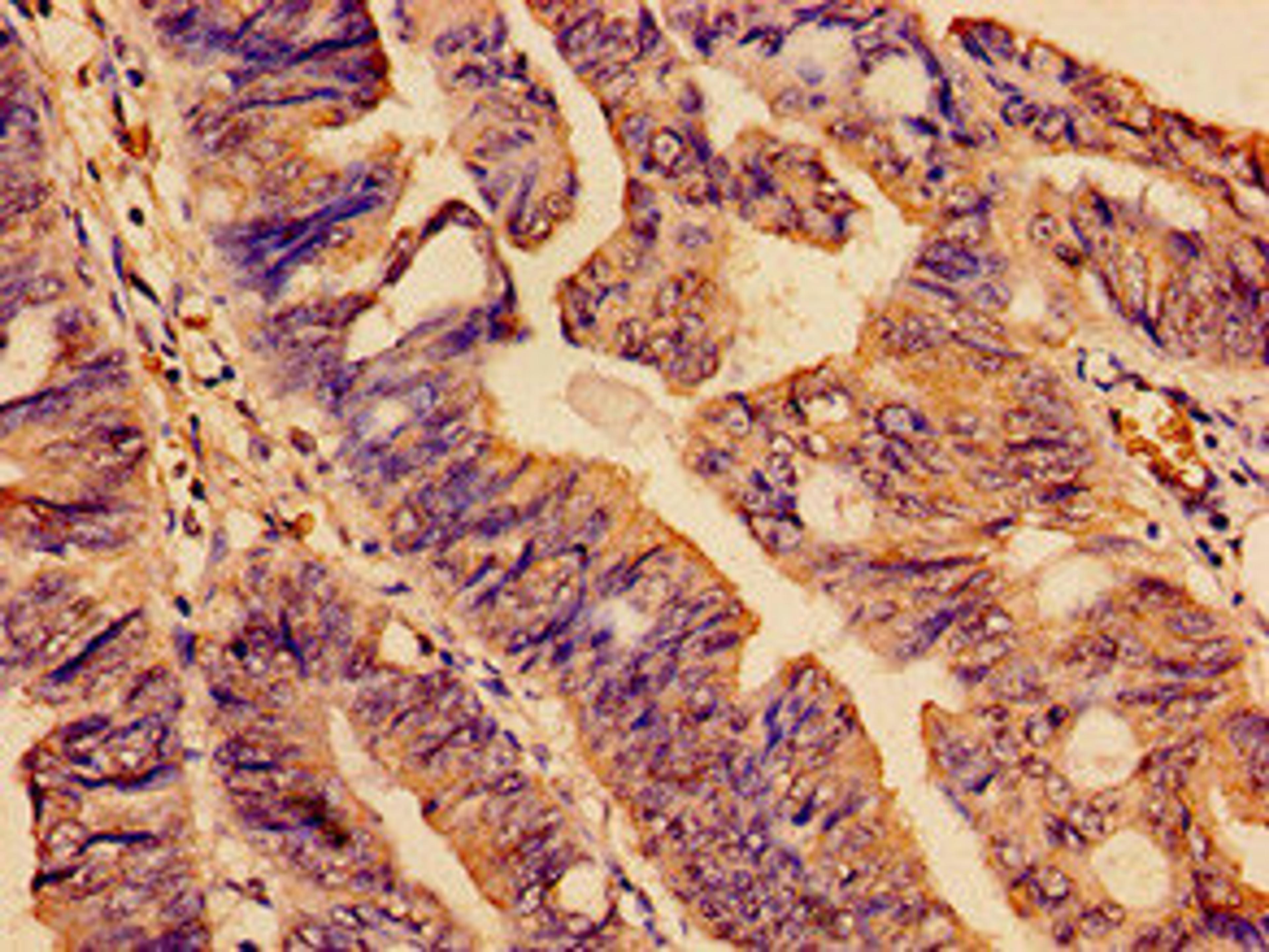 Immunohistochemistry analysis of human colon cancer using CSB-PA885725YA01HU at dilution of 1:100