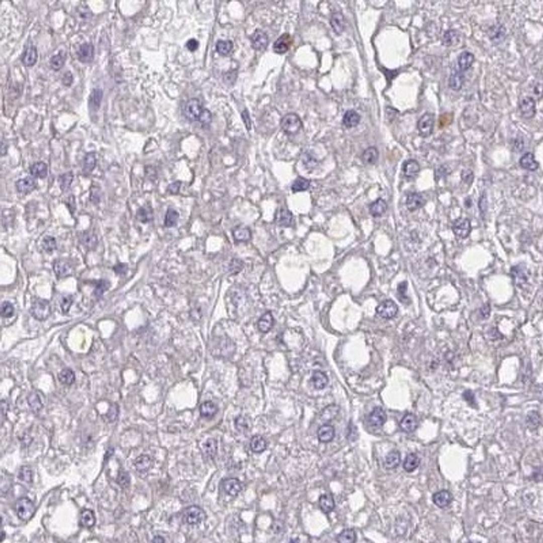 Immunohistochemistry: RTBDN Antibody [NBP2-31610] - liver cancer